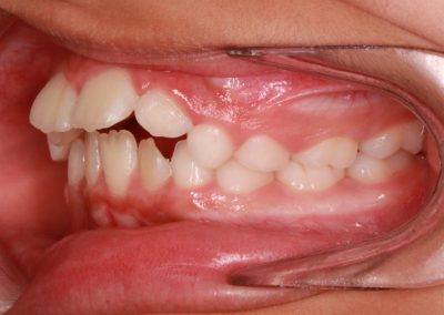 Ortodoncia. Dentista en Alcorcón.