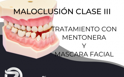 Dentista en Alcorcón: Maloclusión Tipo III – Mentonera y Máscara Facial