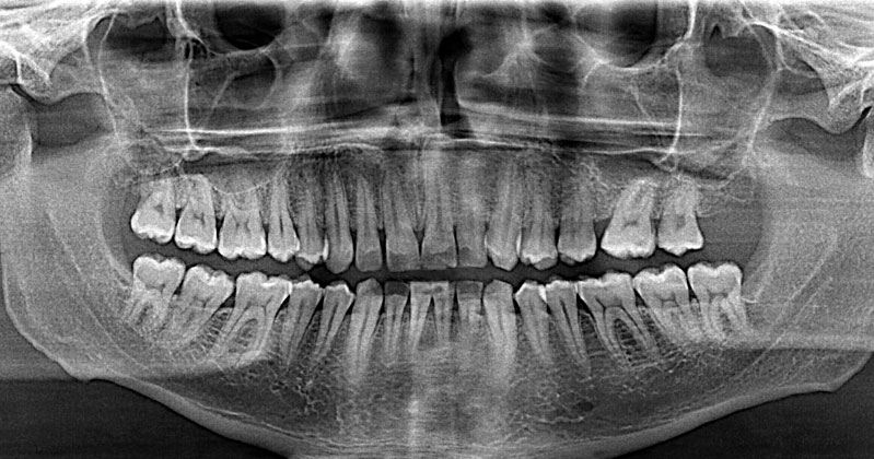 Panorámica dental. dentista en Alcorcón, endodoncia, implantes, ortodoncia