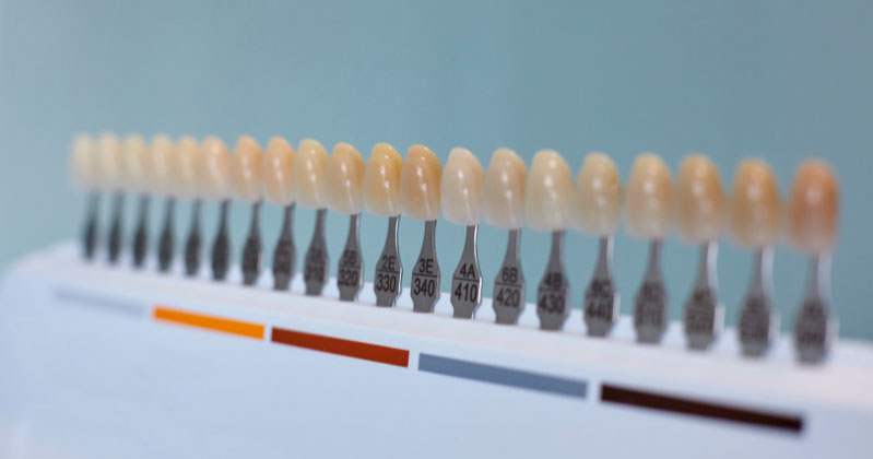 Dentista en Alcorcón- color de dentadura, prótesis, implantes, carillas
