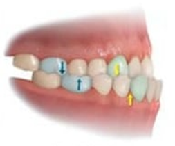 maloclusion clase III
