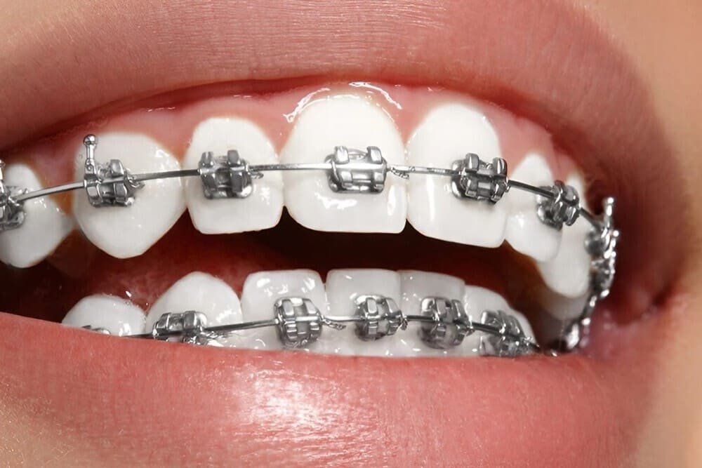 dientes cuidados durante tratamiento ortodoncia