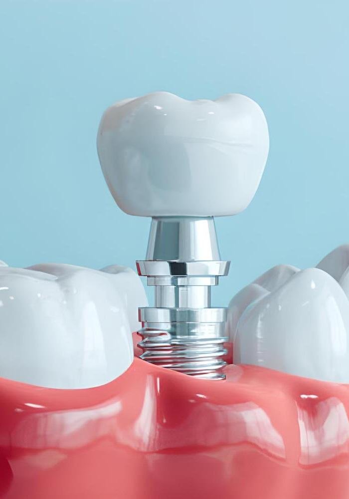 implante dental protesis clinica dental rivera alcorcon