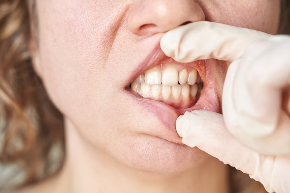 fases de la enfermedad periodontal y perdida osea dental